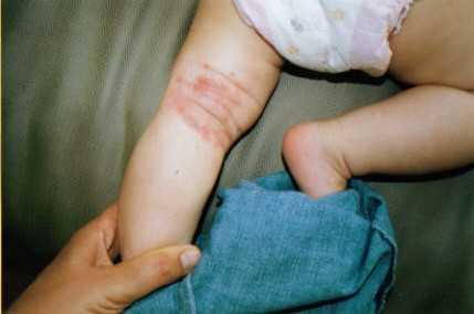 Tahlia Clark eczema behind knee