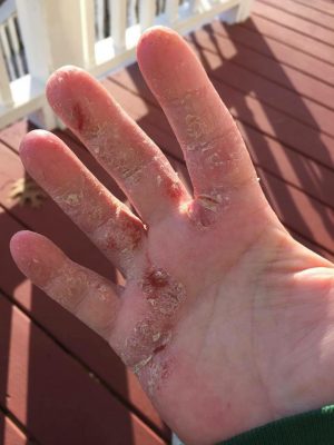 Relief for your hands 2 Brandi Adler 2