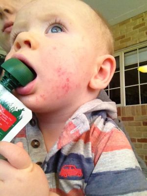 Little Leo's eczema 2 Hayley Jack 2 Leo 7 mths Eczema
