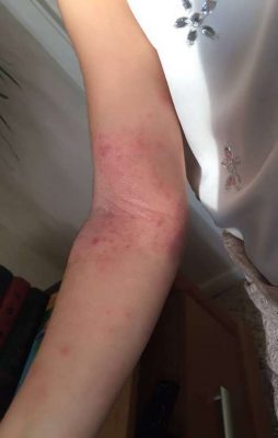 eczema arm before