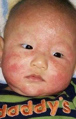 eczema infant before